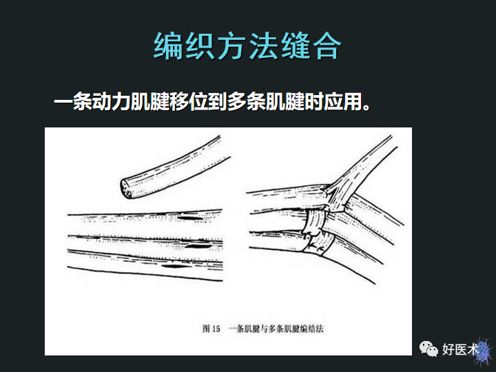 骨科必备技能肌腱缝合固定术，图文详解清晰明了！