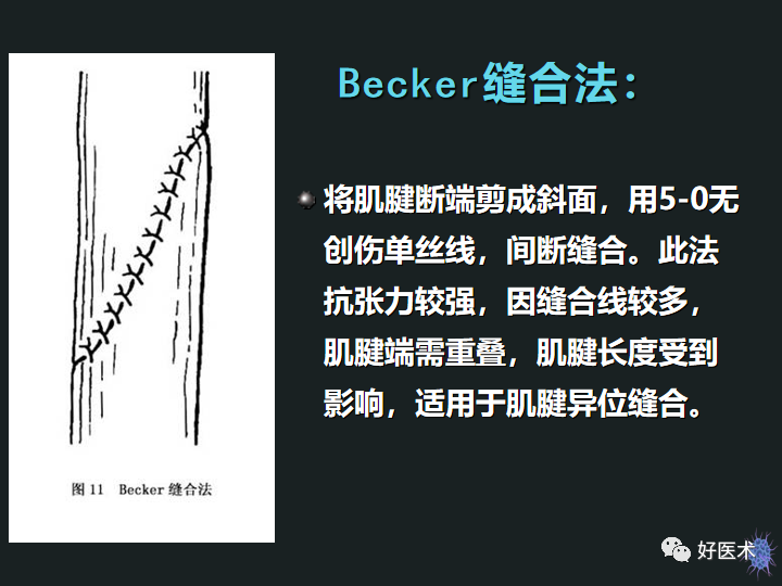 骨科必备技能肌腱缝合固定术，图文详解清晰明了！