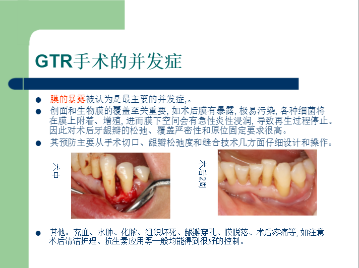 学习引导组织再生术，拯救越来越严重的牙周炎！