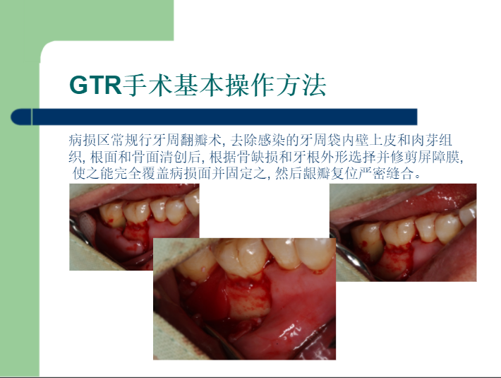 学习引导组织再生术，拯救越来越严重的牙周炎！