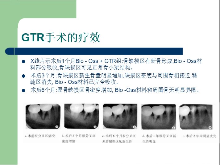 学习引导组织再生术，拯救越来越严重的牙周炎！