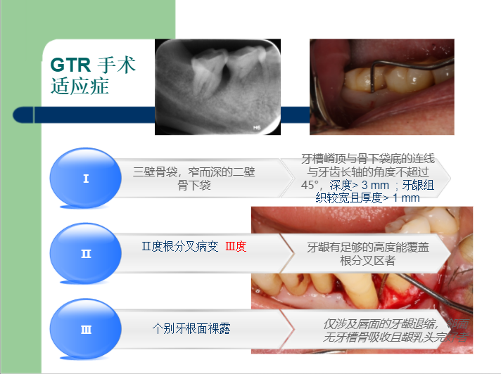 学习引导组织再生术，拯救越来越严重的牙周炎！