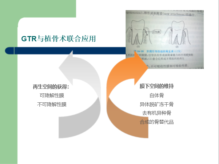 学习引导组织再生术，拯救越来越严重的牙周炎！