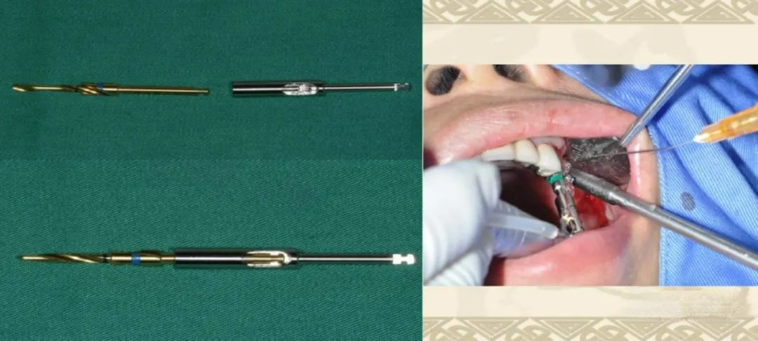 盘点口腔种植手术器械，一文告诉你怎么使用！