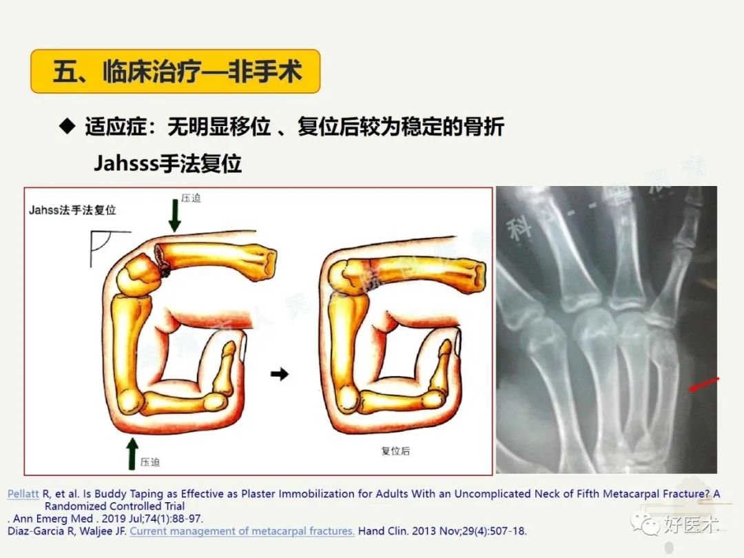 “谈骨论筋”飞图系列课-第三十三期肌骨读片会-中国医学影像联盟-China Medical Imaging Association