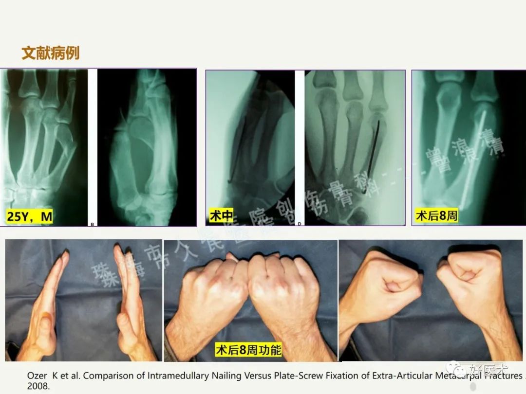 高清图解：第五掌骨颈骨折的临床诊疗策略及技巧！