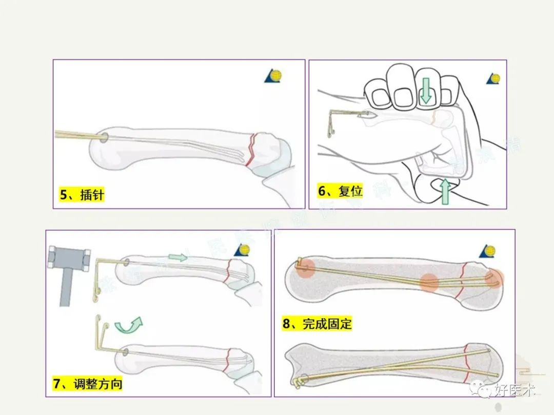高清图解：第五掌骨颈骨折的临床诊疗策略及技巧！