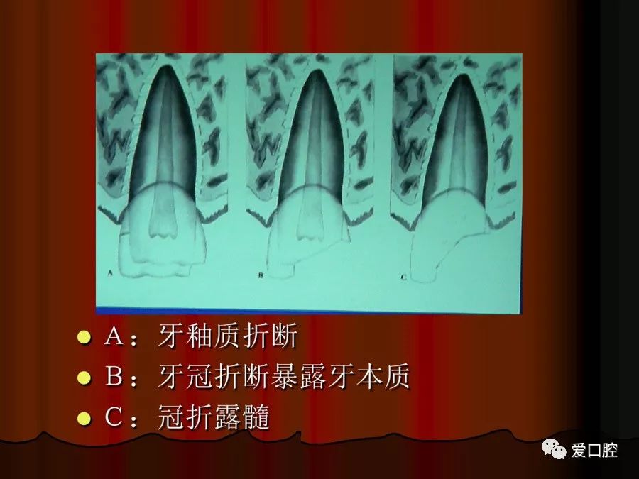 年轻恒牙外伤该怎么处理，看这一篇就够了！