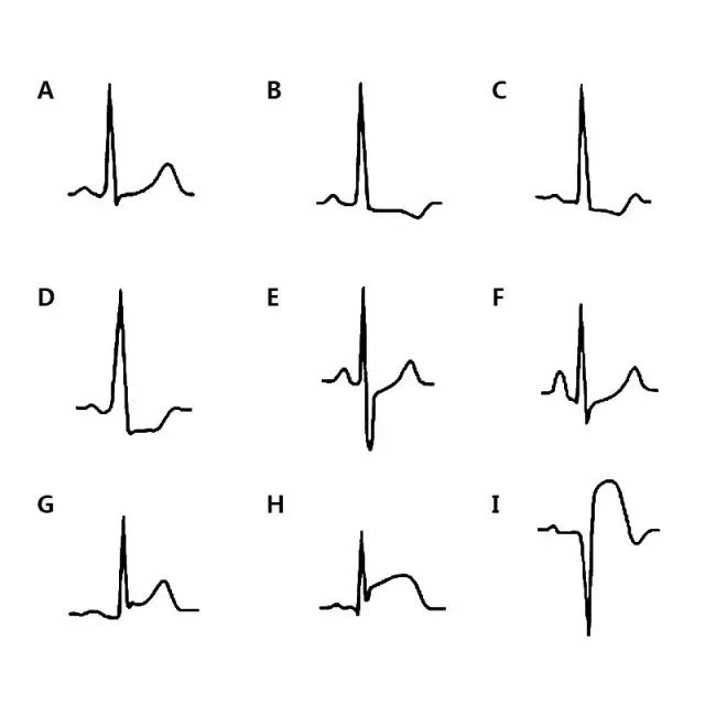 急性心梗心电图各阶段特点，这篇总结的很不错！