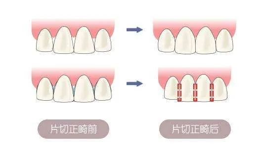 邻面去釉不能随便做，这几点你应该知道！