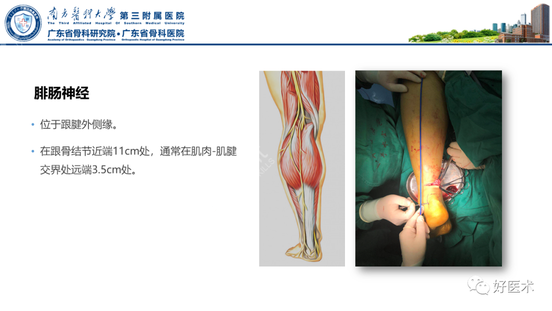 跟腱断裂的修复与重建手术全流程，这篇课件讲解打满分！