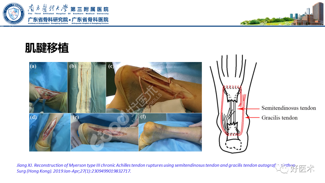 跟腱断裂的修复与重建手术全流程，这篇课件讲解打满分！