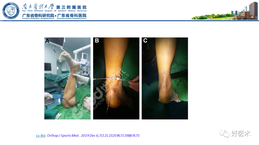 跟腱断裂的修复与重建手术全流程，这篇课件讲解打满分！