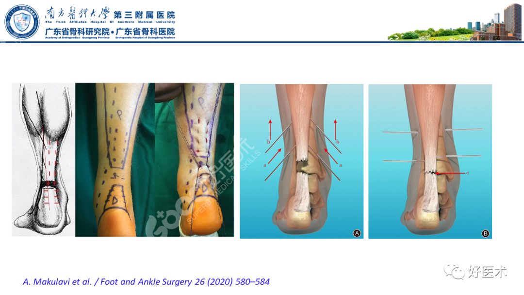 跟腱断裂的修复与重建手术全流程，这篇课件讲解打满分！