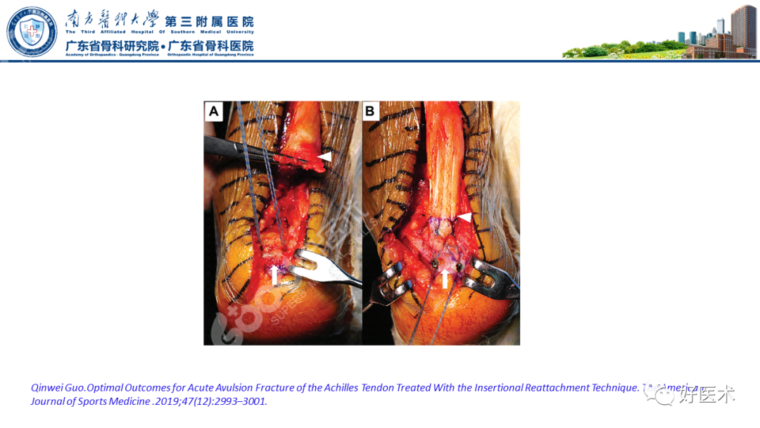 跟腱断裂的修复与重建手术全流程，这篇课件讲解打满分！