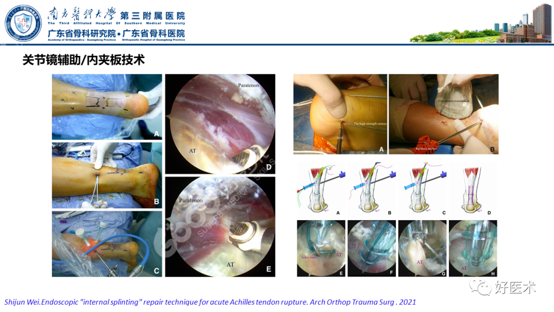 跟腱断裂的修复与重建手术全流程，这篇课件讲解打满分！