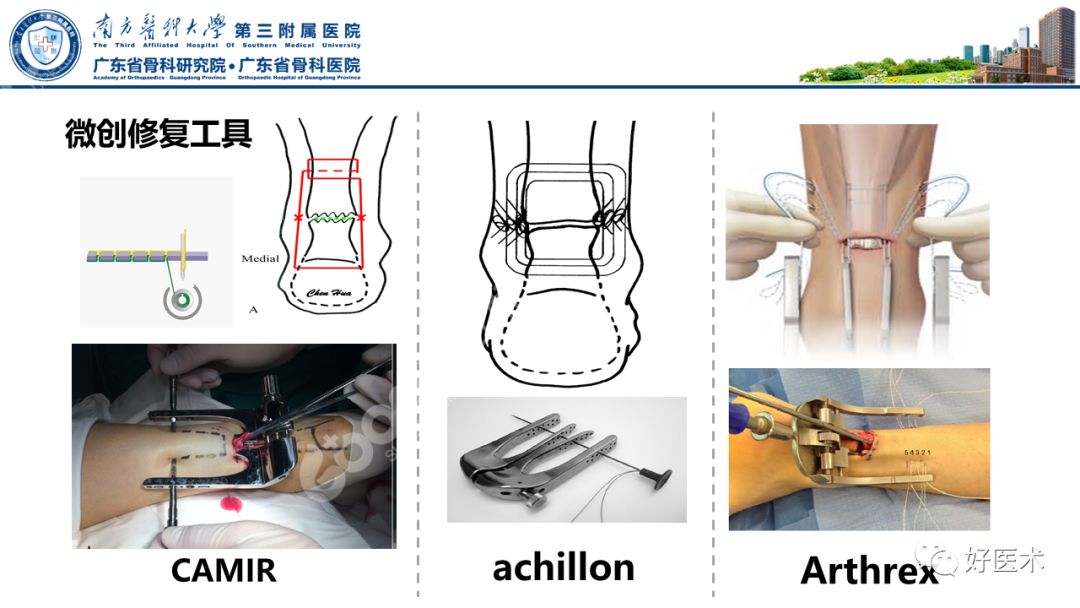 跟腱断裂的修复与重建手术全流程，这篇课件讲解打满分！