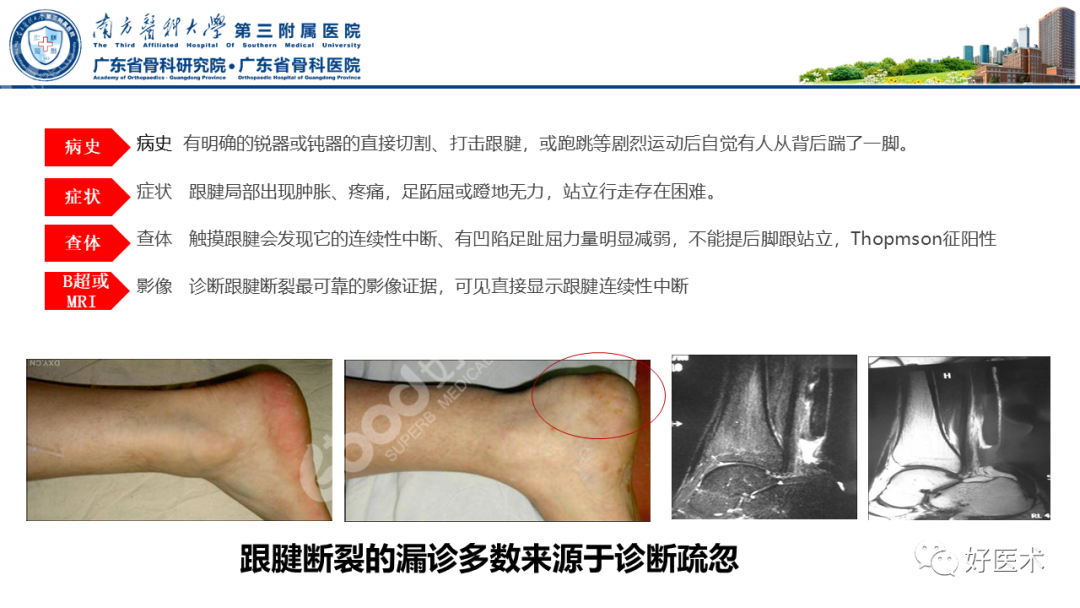 跟腱断裂的修复与重建手术全流程，这篇课件讲解打满分！