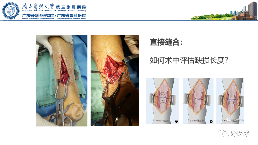 跟腱断裂的修复与重建手术全流程，这篇课件讲解打满分！