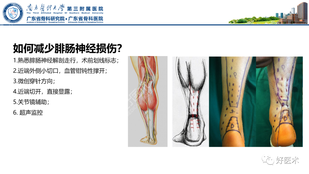 跟腱断裂的修复与重建手术全流程，这篇课件讲解打满分！