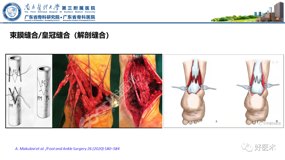 跟腱断裂的修复与重建手术全流程，这篇课件讲解打满分！