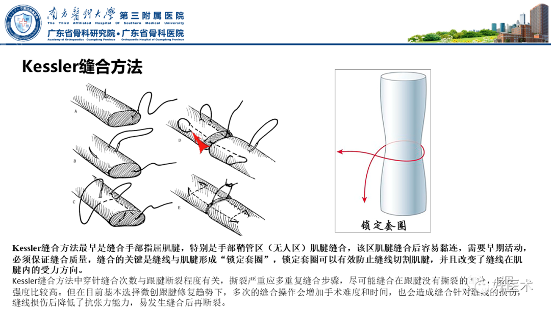 跟腱断裂的修复与重建手术全流程，这篇课件讲解打满分！