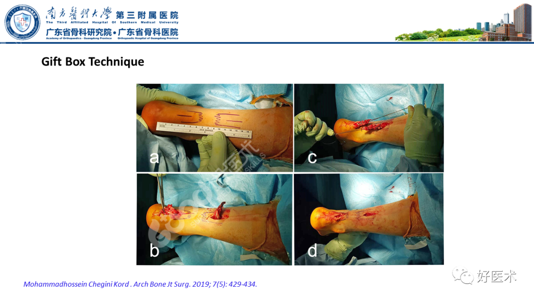 跟腱断裂的修复与重建手术全流程，这篇课件讲解打满分！