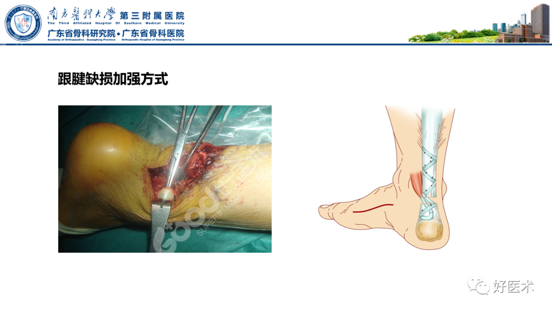 跟腱断裂的修复与重建手术全流程，这篇课件讲解打满分！