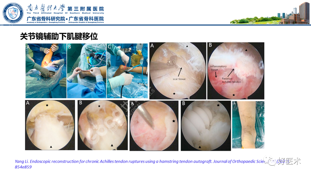 跟腱断裂的修复与重建手术全流程，这篇课件讲解打满分！