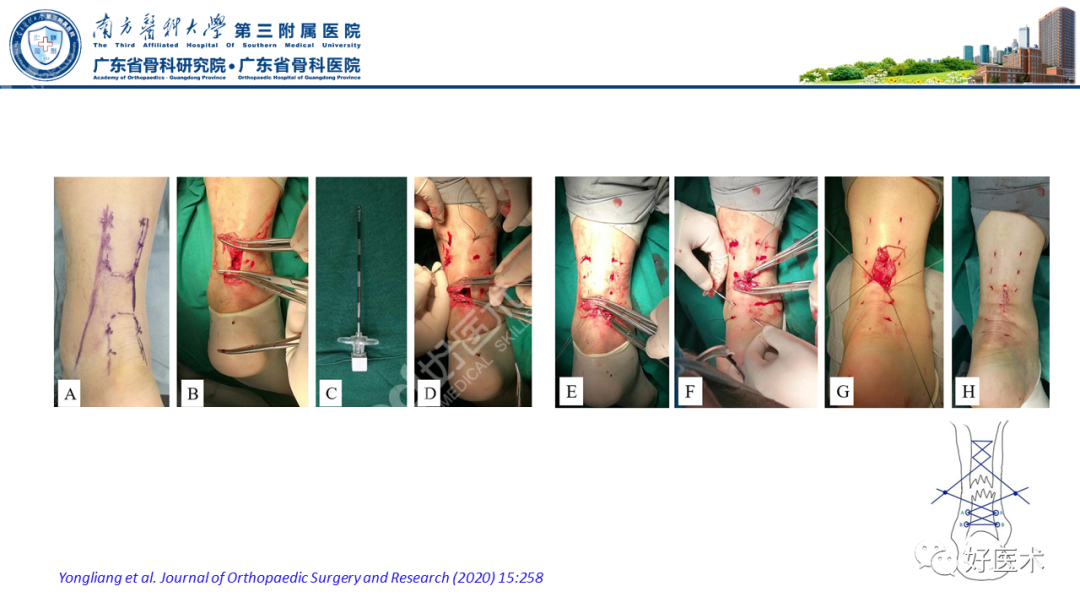 跟腱断裂的修复与重建手术全流程，这篇课件讲解打满分！