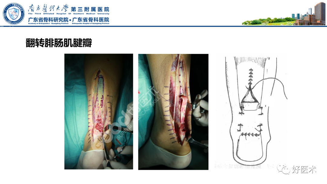 跟腱断裂的修复与重建手术全流程，这篇课件讲解打满分！