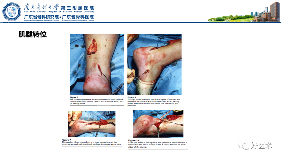 跟腱断裂的修复与重建手术全流程，这篇课件讲解打满分！