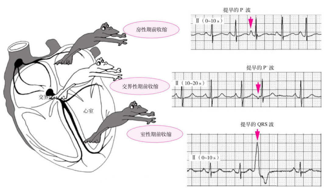 总结！多图详解期前收缩的心电图表现以及诊治要点！