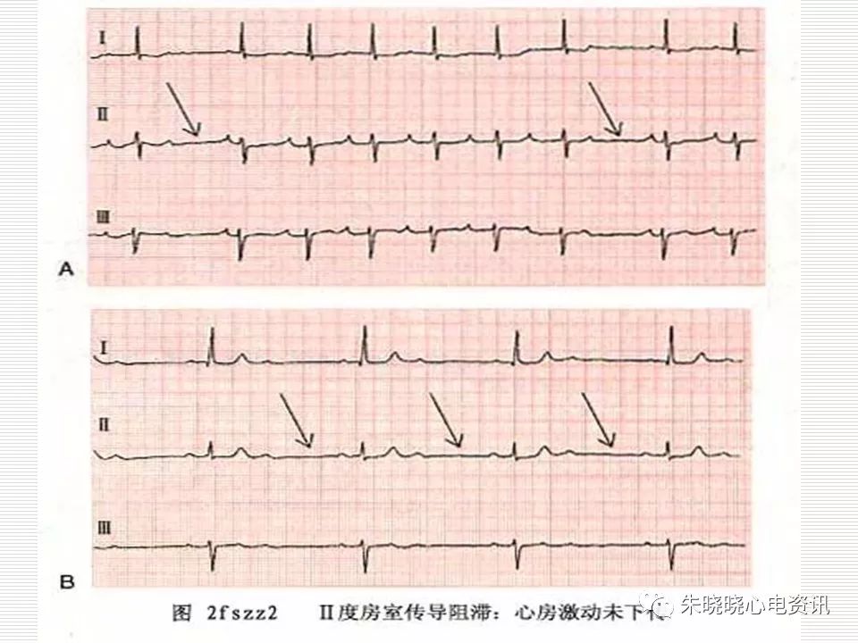 心电图危急值识别与诊断，这篇一定要收藏！