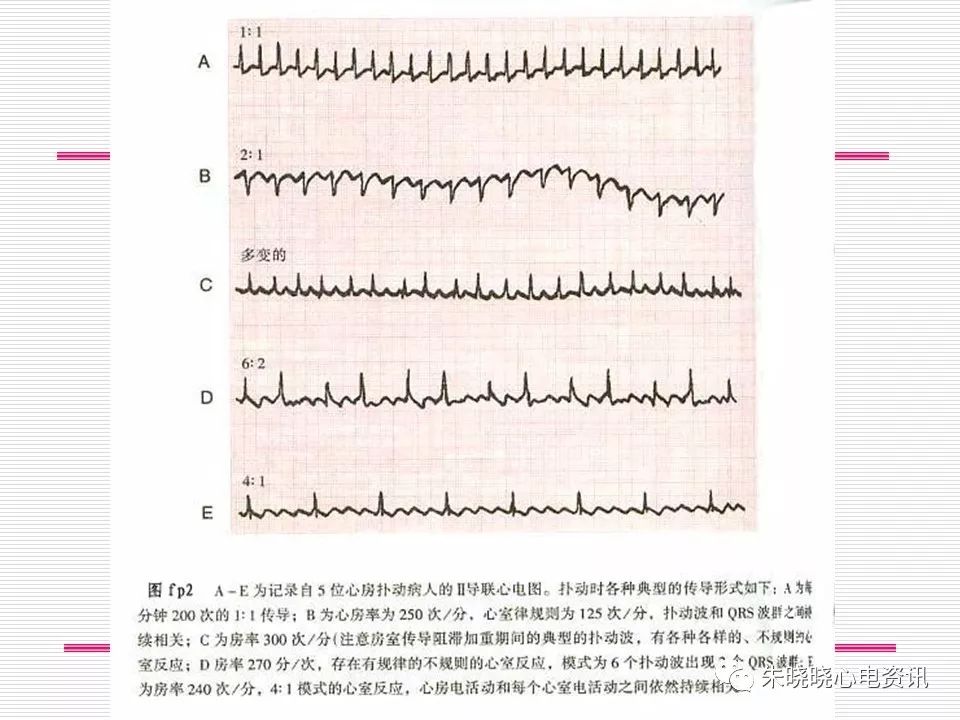 心电图危急值识别与诊断，这篇一定要收藏！
