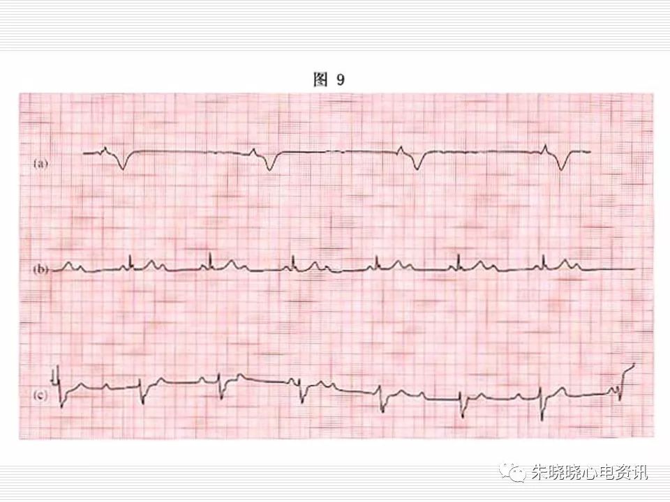 心电图危急值识别与诊断，这篇一定要收藏！