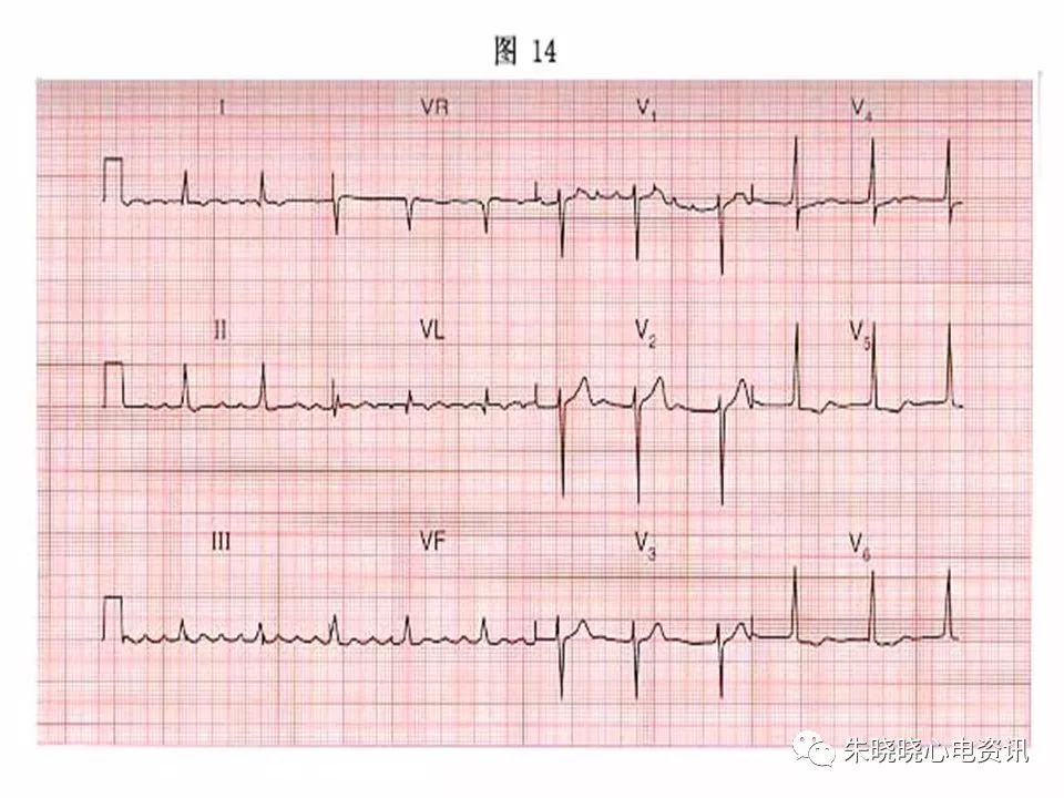 心电图危急值识别与诊断，这篇一定要收藏！