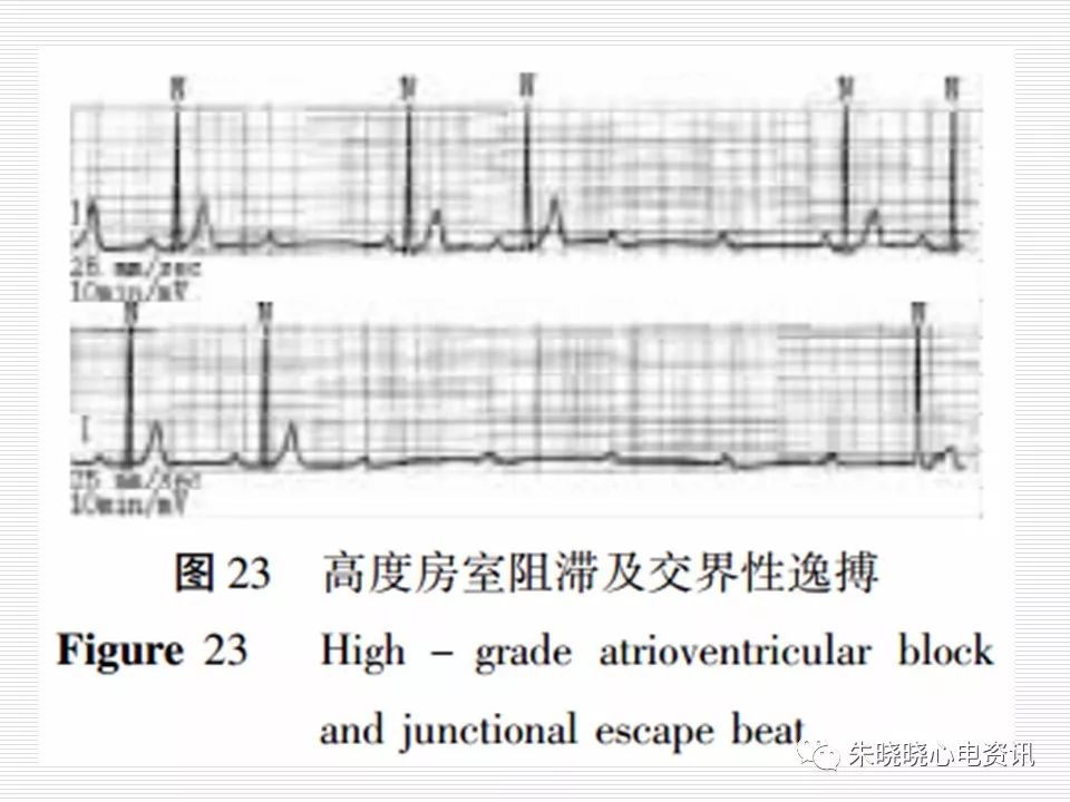 心电图危急值识别与诊断，这篇一定要收藏！