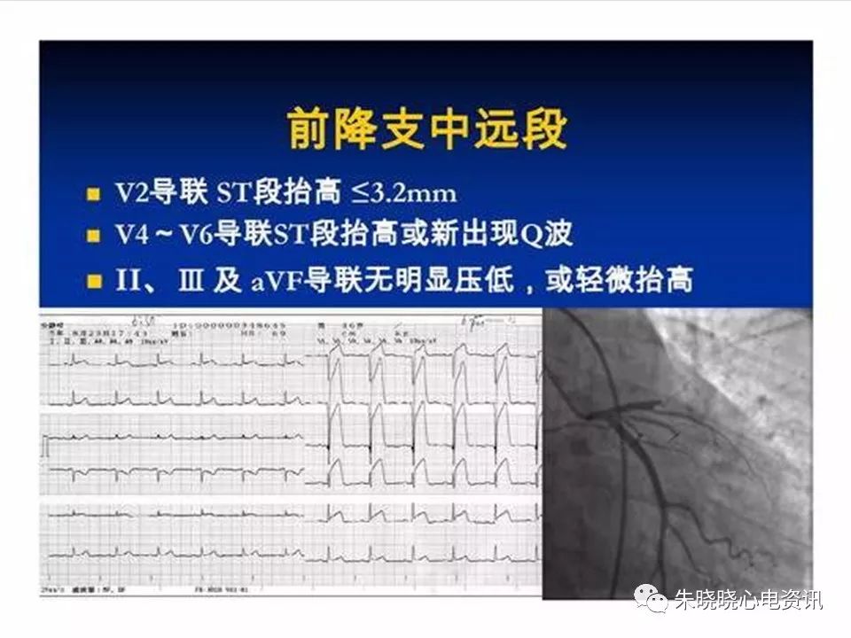 心电图危急值识别与诊断，这篇一定要收藏！