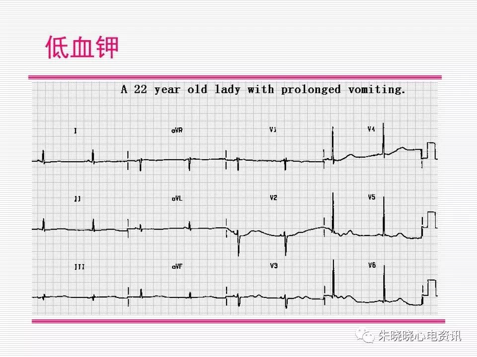 心电图危急值识别与诊断，这篇一定要收藏！
