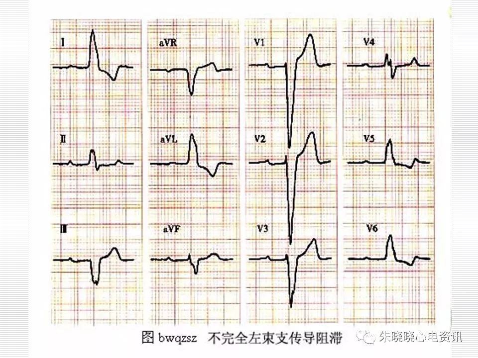 心电图危急值识别与诊断，这篇一定要收藏！