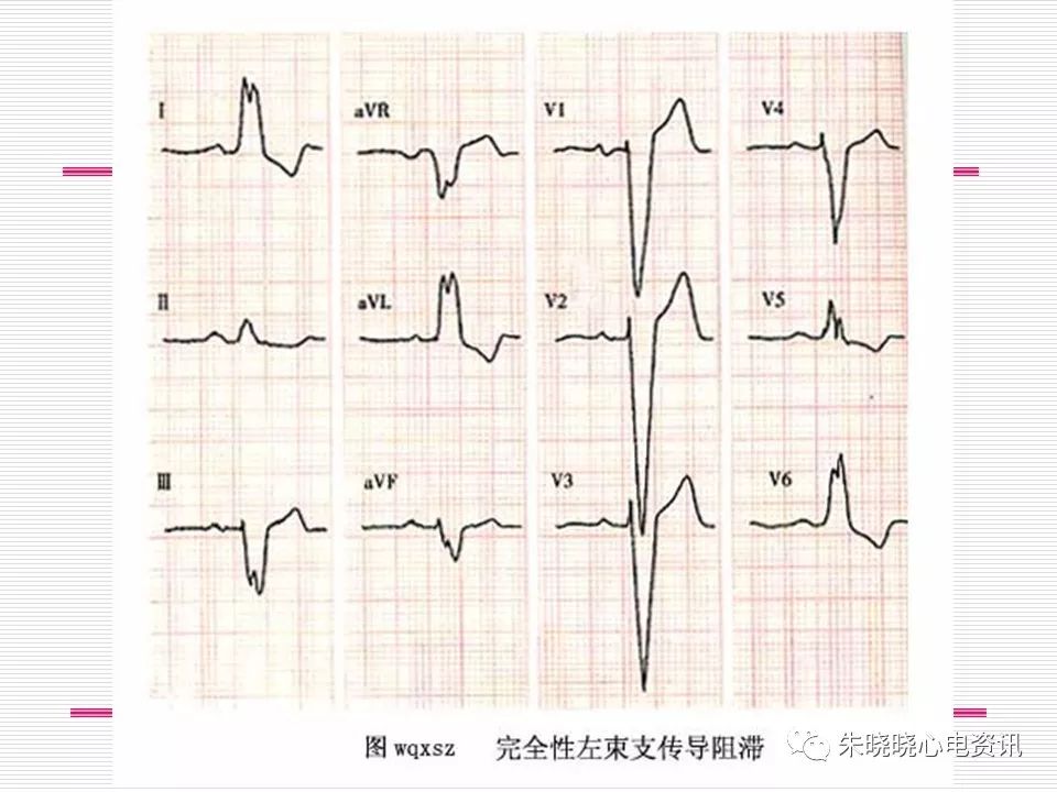 心电图危急值识别与诊断，这篇一定要收藏！