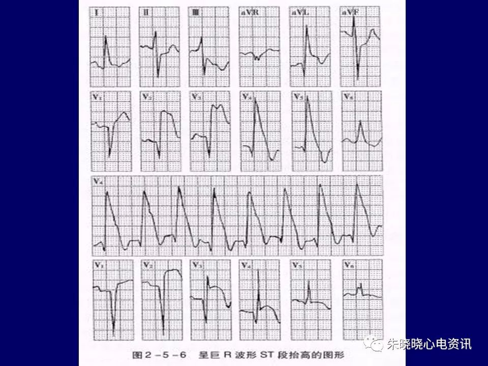 心电图危急值识别与诊断，这篇一定要收藏！