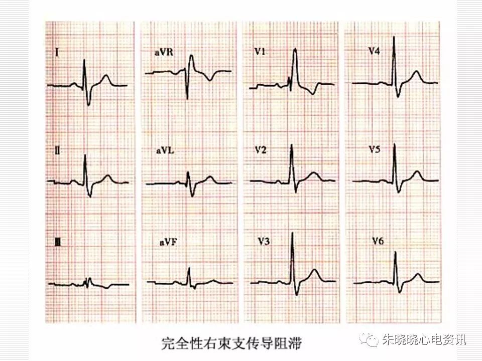 心电图危急值识别与诊断，这篇一定要收藏！