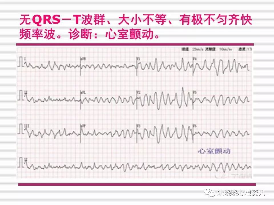 心电图危急值识别与诊断，这篇一定要收藏！