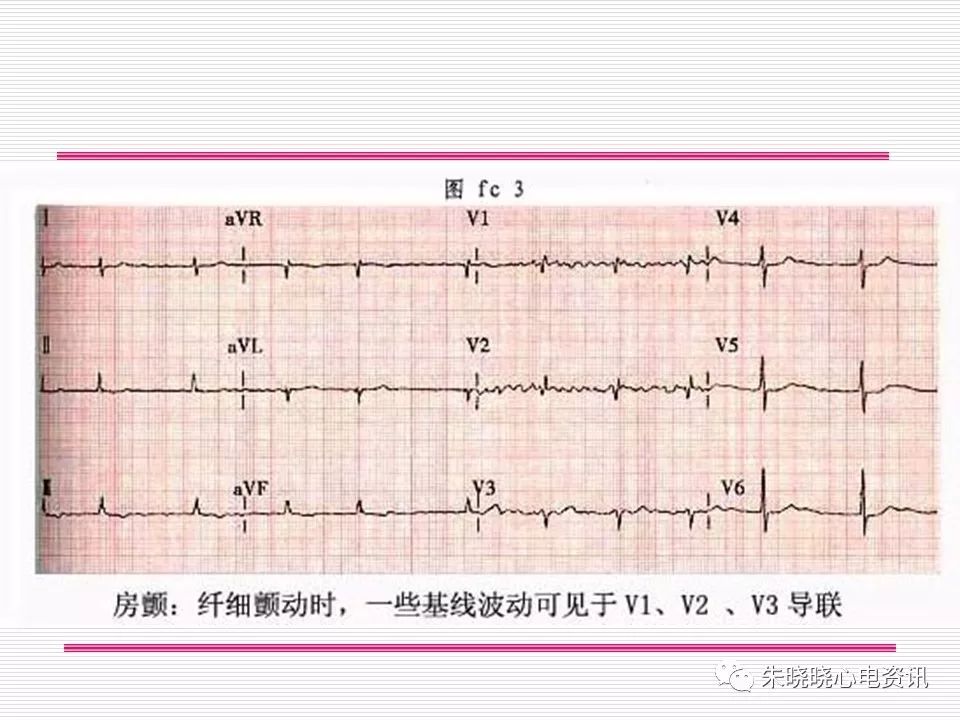 心电图危急值识别与诊断，这篇一定要收藏！