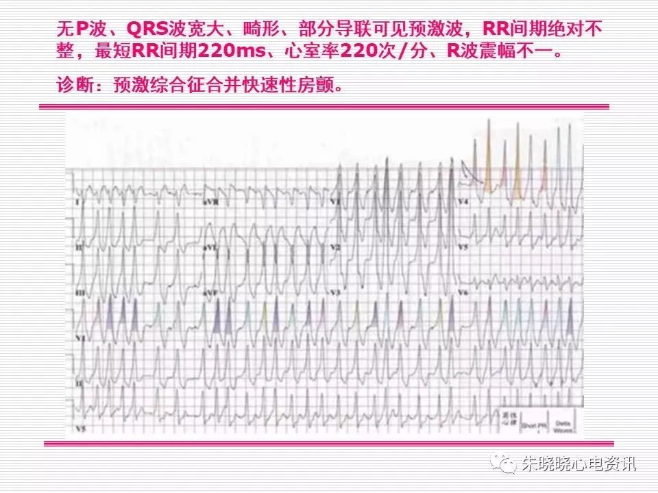 心电图危急值识别与诊断，这篇一定要收藏！