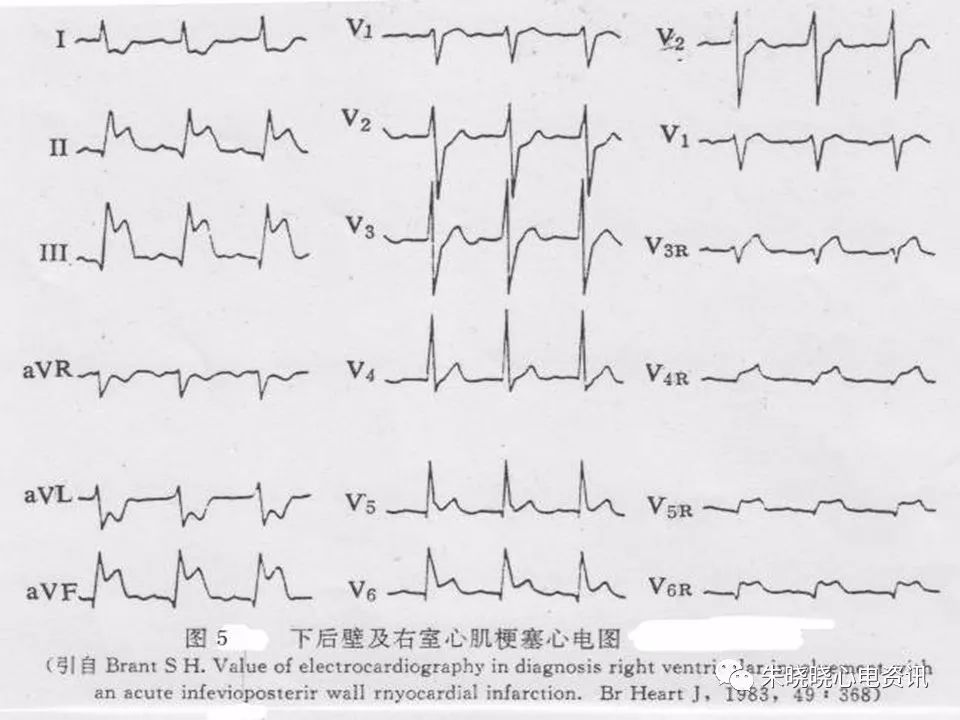 心电图危急值识别与诊断，这篇一定要收藏！