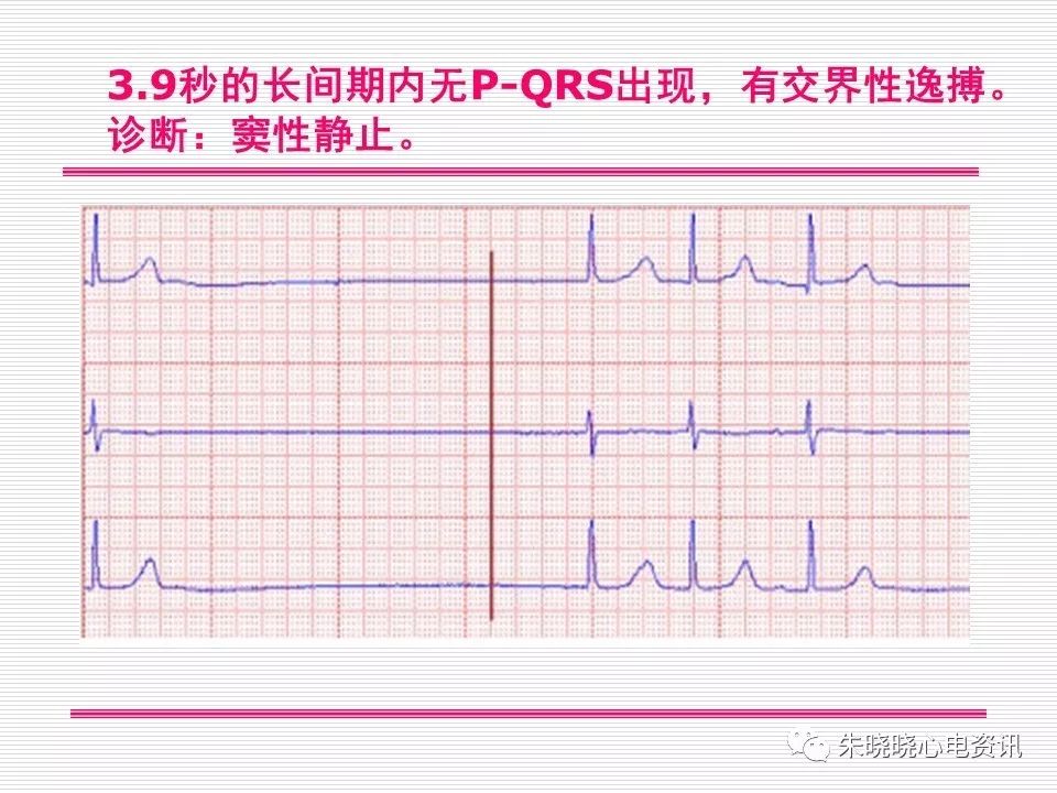 心电图危急值识别与诊断，这篇一定要收藏！