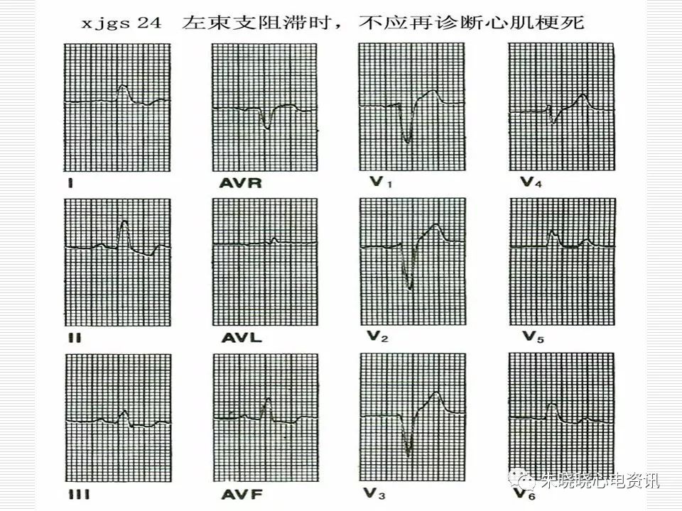 心电图危急值识别与诊断，这篇一定要收藏！